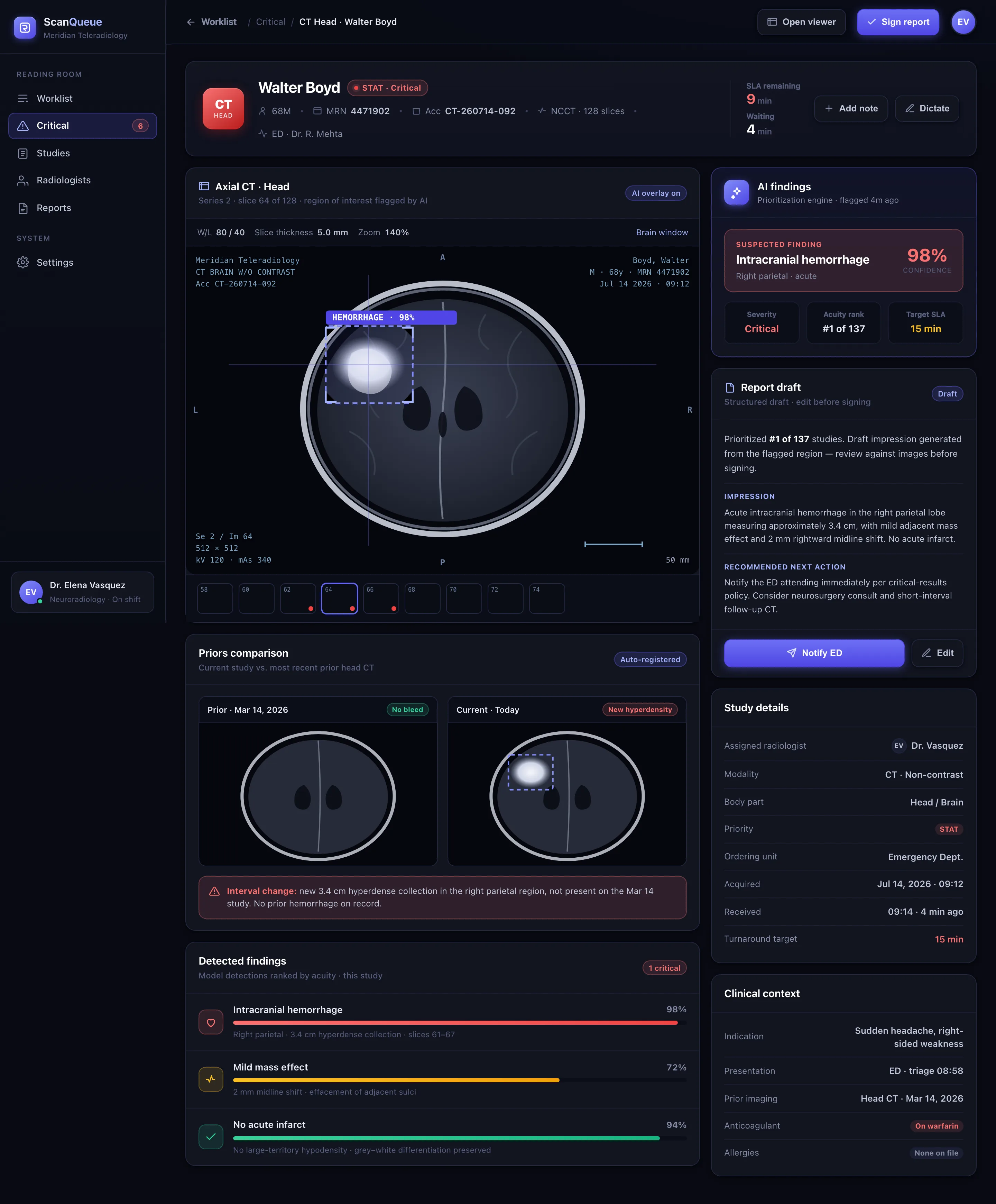 ScanQueue study detail: an axial CT head with an AI bounding box on a suspected hemorrhage, a priors comparison, detected findings with confidence bars, and a report draft with the recommended next action.